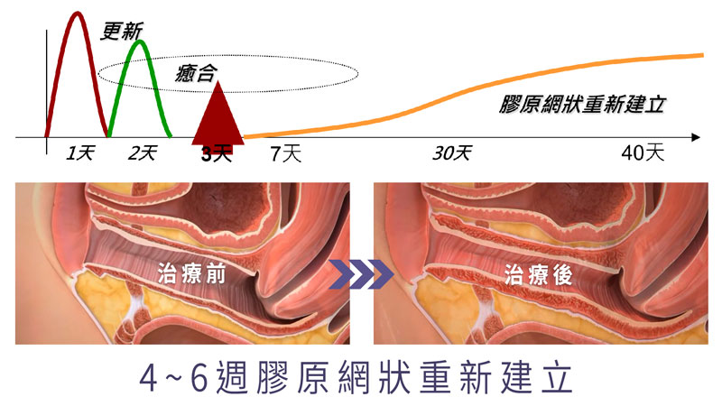膠原網狀重新建立,刺激膠原蛋白,彈力蛋白新生